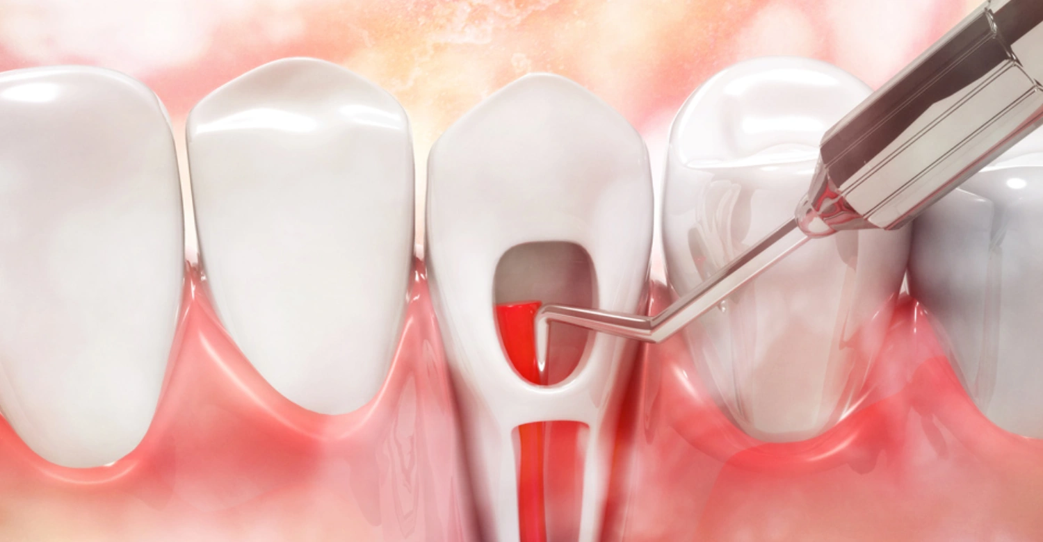 What is a Root Canal Front Tooth Treatment Inblog